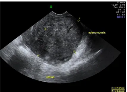 Gambar  4.3  Tampilan  USG  yang  menunjukkan  adenomiosis  melibatkan  bagian  posterior  uterus