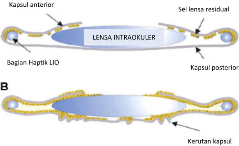 Gambar 2.1 Skema sel residu epitel lensa yang tersisa pasca operasi katarak          Dikutip dari: Wormstone, M, Wang, L 7 