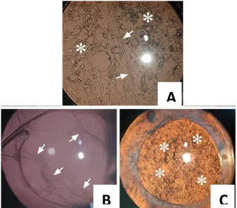 Gambar 2.1 Gambaran opasifikasi kapsular. (A) Opasifikasi campuran tipe fibrosis dan           pearl