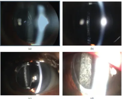 Gambar 3.1 Grading dari opasifikasi kapsul posterior secara umum yang                        Dilakukan berdasarkan pemeriksaan lampu celah