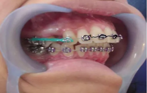 Gambar 1 :Retraksi gigi kaninus maksila menggunakan elastomeric chain  dengan continuous round wire stainless steel � 0,016