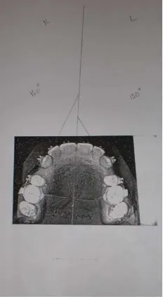 Gambar 4. Fotokopi model studi untuk pengukuran rotasi gigi kaninus 