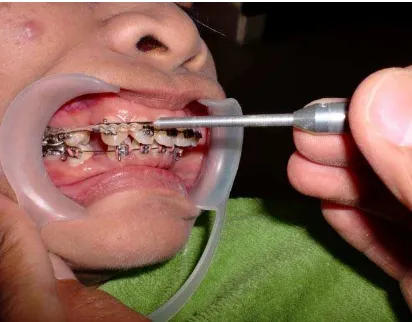 Gambar 6gram yang akan digunakan untuk retraksi gigi kaninus dengan elastomeric 