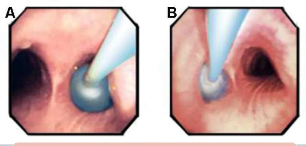 Gambar 3. A) bronchial balloon fully inflated in the entrance of  right bronchus and B) on the left main bronchus