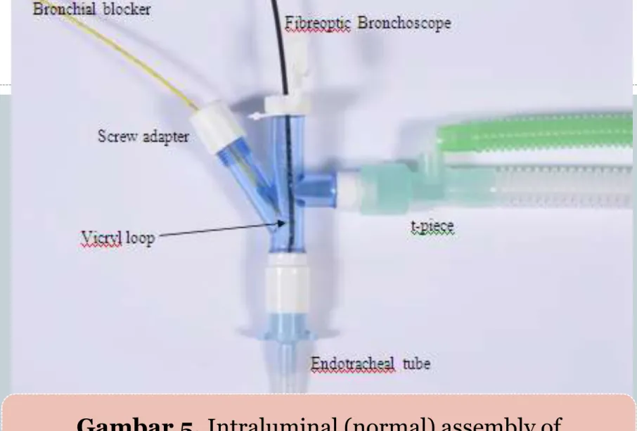 Gambar 5. Intraluminal (normal) assembly of   endobronchial blocker connector 