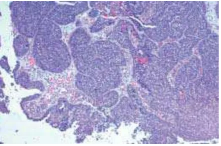 Gambar 2.2. Karsinoma sel skuamosa, non-keratinizing. Pulau-pulau sel-sel tumor kohesif menginvasi ke dalam stroma dibawahnya