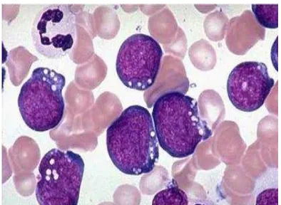 Gambar  4: Leukemia limfoblastik akut tipe L-3 (Arceci et al, 2007) 