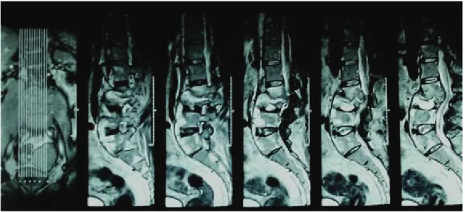 Gambar 1. MRI T 2 WI Sagital tanpa kontras segmen servikal. Tampak destruksi C 6  dan C 7  yang mendesak medula spinalis
