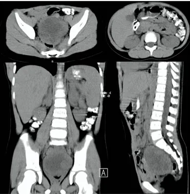 Gambar 1. CT scan abdomen-pelvis non kontras tanggal 11-03-2016