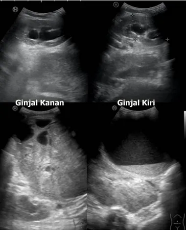 Gambar 3. CT scan abdomen-pelvis non kontras tanggal 04-07-2016