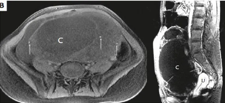 Gambar 8. Sagittal T2-weighted MRI menunjukkan massa cystic unilocular (c) besar yang menempati rongga pelvis