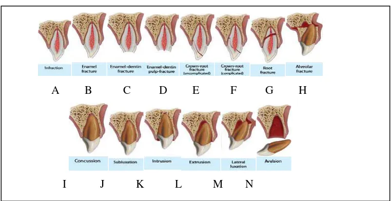 Gambar 3. A. Infraksi (infarction) B. Fraktur enamel (enamel fracture) C.  Fraktur enamel-dentin (enamel-dentin fracture) D
