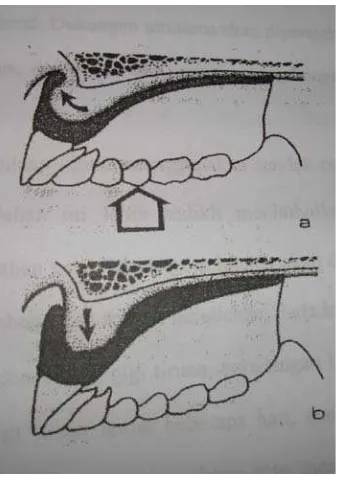 Gambar 5. (a) Dibawah tekanan oklusal, gigi tiruan atas terletak pas dan prosesus 