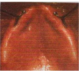 Gambar 3 (a). Jaringan yang flabby menutupi daerah anterior RA  