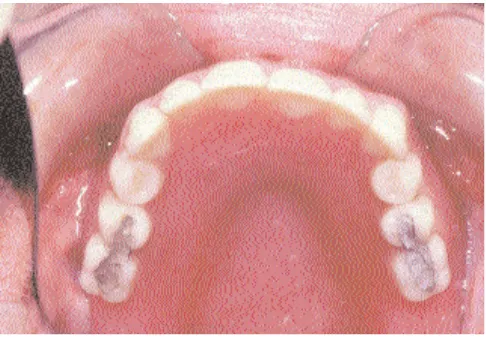 Gambar 4.1 Gigi tiruan lengkap rahang atas dengan amalgam pada permukaan oklusal gigi artifisial posterior 