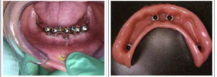 Gambar 4.2 Penggunaan implant sebagai penyangga gigi tiruan lengkap fixed 