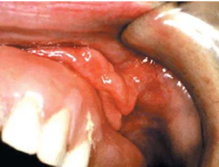 Gambar 2.1 Hiperplasia pada palatum keras dan linggir 