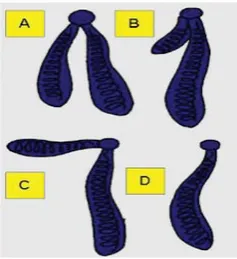 Gambar 6. Struktur Kromosom  Berdasarkan Letak Sentromer Sumber: http:// biologyondemand.