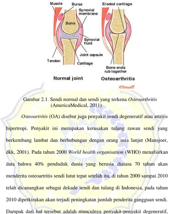 Gambar 2.1. Sendi normal dan sendi yang terkena Osteoarthritis  (AmericaMedical, 2011) 