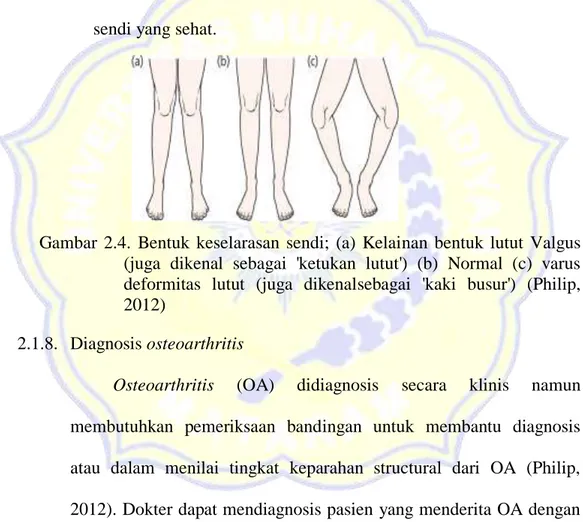Gambar  2.4.  Bentuk  keselarasan  sendi;  (a)  Kelainan  bentuk  lutut  Valgus  (juga  dikenal  sebagai  'ketukan  lutut')  (b)  Normal  (c)  varus  deformitas  lutut  (juga  dikenalsebagai  'kaki  busur')  (Philip,  2012) 