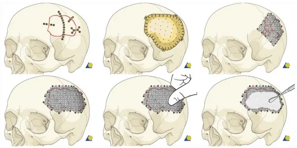 Gambar 1. Metode Cranioplasty dalam Dunia Medis (AO online, 2015) 