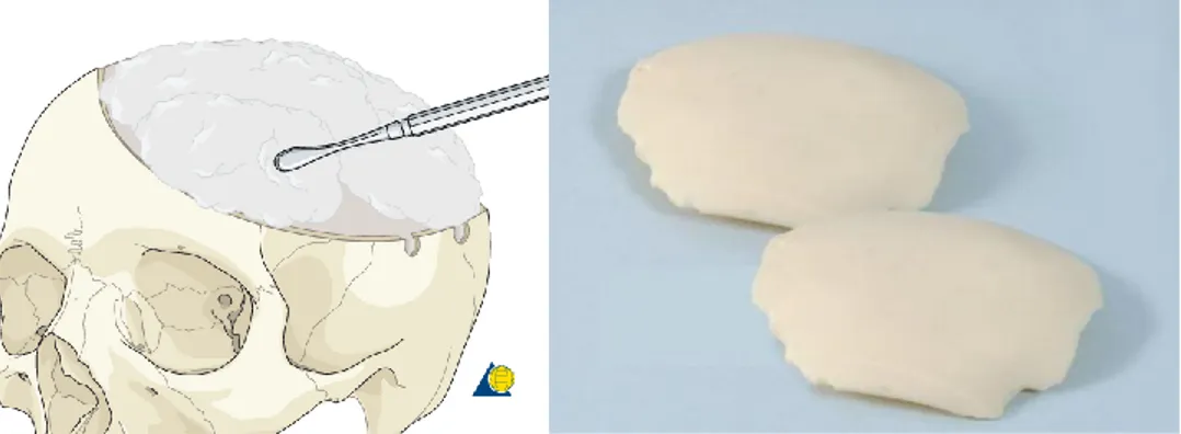 Gambar 2. Metode Cranioplasty intraoperative dengan bahan PMMA/acrylic bone  cement (AO online, 2015) 
