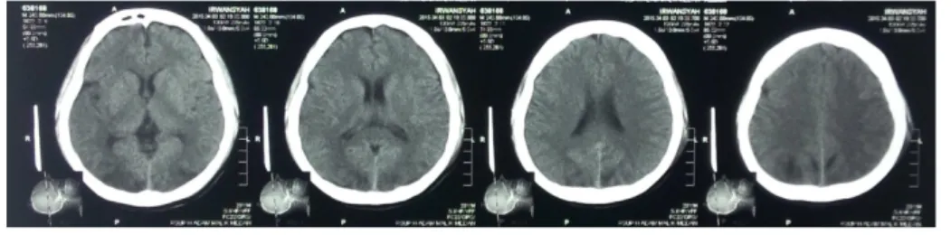 Gambar 1. Gambaran CT scan Kepala Pasien 