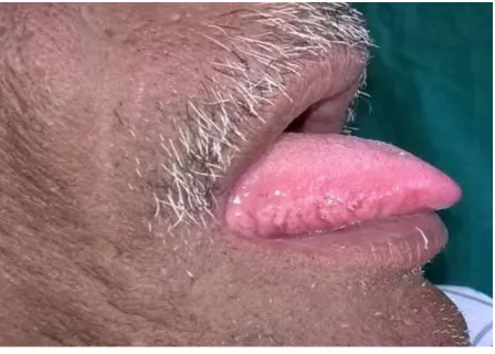 Figure 1. Photograph of the patient showing blood illed bullae on the right lateral border of the tongue