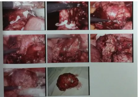 Gambar 2 Tumor Adrenal pada Kasus Kedua