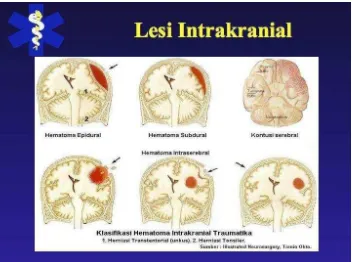 Gambar 2.7 Lesi intrakranial (Tomio Ohee , 2000) 