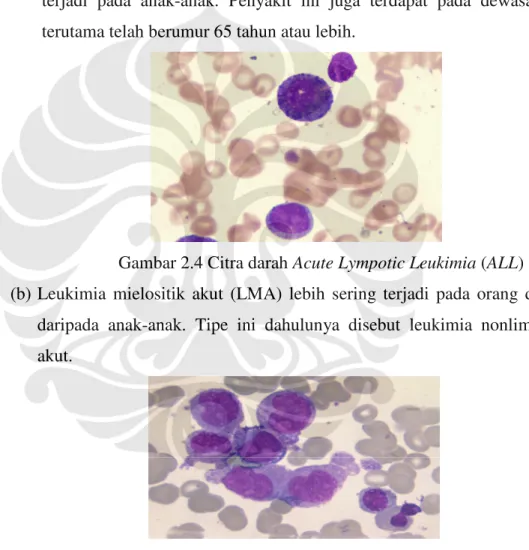 Gambar 2.4 Citra darah Acute Lympotic Leukimia (ALL) 