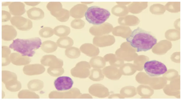Gambar 2.6 Citra darah Chronic Lymphocityc Leukimia (CLL)  (d)  Leukimia  mielositik  kronis  (LMK)  sering  terjadi  pada  orang  dewasa
