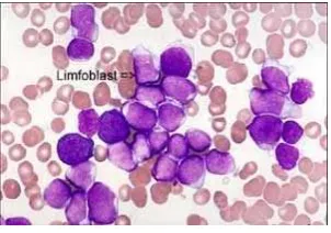 Gambar 2.8.  Leukemia Limfositik Akut  