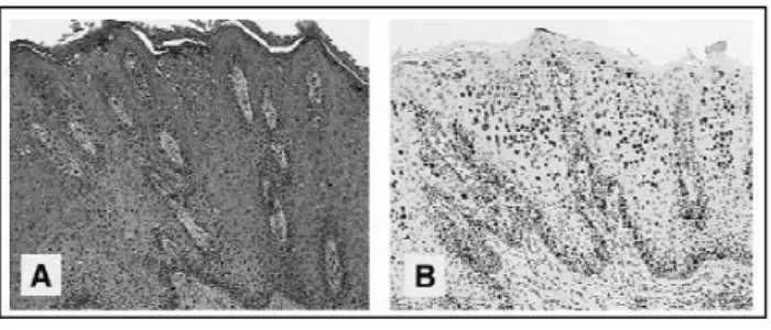 Gambar 2.(A) MIB-1 immunostaining hadir 
