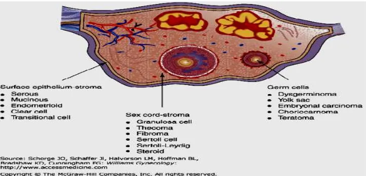 Gambar 1. Tiga tipe utama tumor ovarium15 