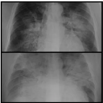 Gambar 2. Gambaran pneumonia berat pada COVID-19. 