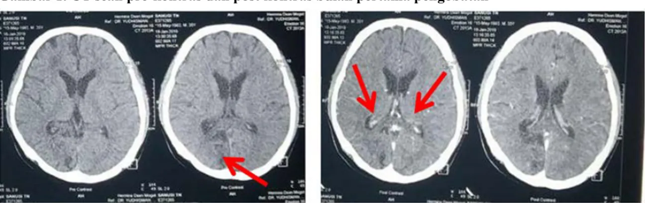 Gambar 2. CT scan pre-kontras dan post kontras pada bulan ke-12 pengobatan