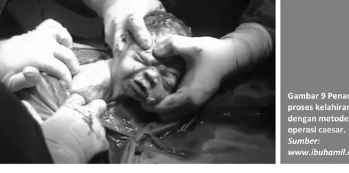 Gambar 9 Penanganan  proses kelahiran bayi  dengan metode  operasi caesar.  Sumber: 