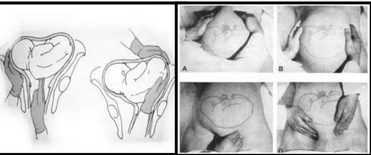 Gambar  10  Posisi  bayi  dalam  keadaan  melintang  dalam  rahim  dan  cara  penanangannya