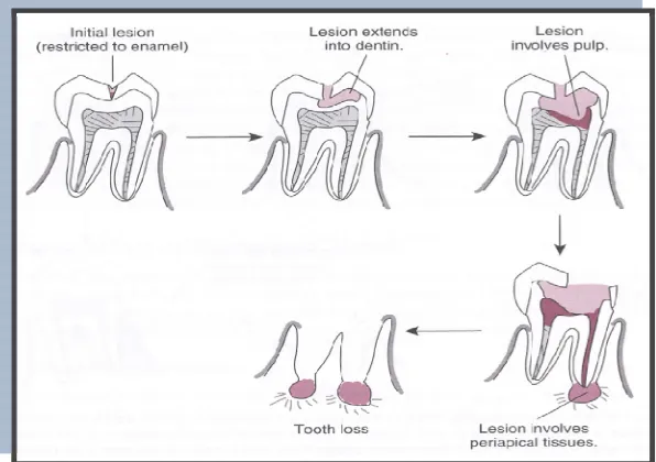 Gambar.2. Karies gigi menyebabkan tooth loss.Dikutip dari : Powers J.M, Wataha  J.C. Dental Material:Properties and Manipulation
