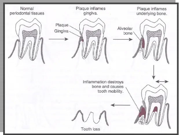 Gambar.3.Penyakit  periodontal menyebabkan tooth loss.Dikutip dari : Powers J.M, Wataha  J.C
