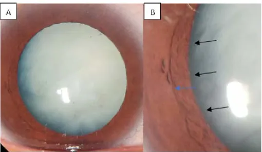Gambar 1. Foto segmen anterior mata kanan. (A) Katarak Nuklear,             (B) koeppe (tanda panah hitam),  bussaca  (tanda panah biru)