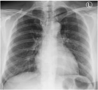 Gambar 2.  Foto rontgen thorax dengan hasil corakan bronchovasculer  bertambah dan tampak noda keras minimal dilapang atas paru  kiri dan perihiler bilateral 