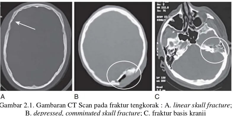Gambar 2.1. Gambaran CT Scan pada fraktur tengkorak : A. linear skull fracture; 