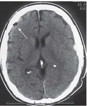 Gambar 2.2. Gambaran CT Scan kepala yang menunjukkan adanya udara pada  intrakranial 