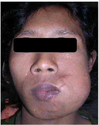 Gambar 1. Gambaran ekstra oral berupa pembengkakan pada regio bukal kiri mandibula dan menyebabkan wajah asimetris.5 