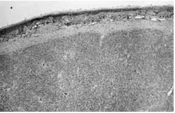 Gambar 2. Gambaran mikroskopis menunjukkan adanya batas perifer dan kapsul pada cemento ossifying fibroma.4 