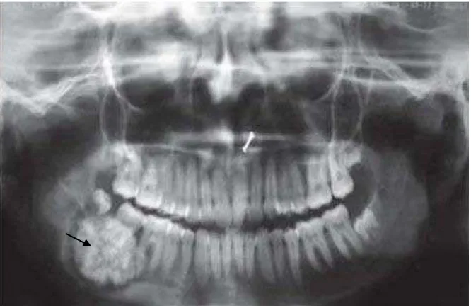Gambar 6. Gambaran radiografi Panoramik Cemento ossifiying fibroma pada mandibula.9 