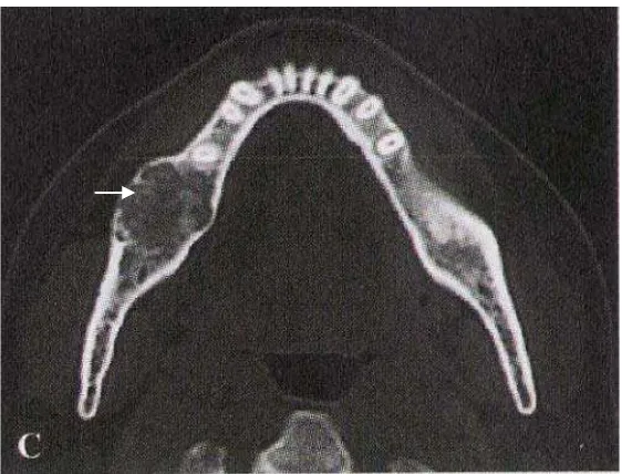 Gambar 7. CT Scan foto menunjukkan lesi juga ekspansi kearah bukal dan lingual dengan bentuk tulang trabekular terlihat jelas dalam lesi, korteks bukal mengalami erosi dan menjadi sangat tipis.12 