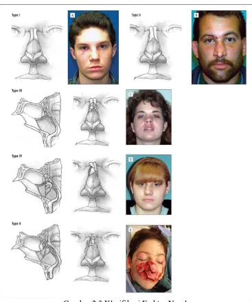 Gambar 2.3 Klasifikasi Fraktur Nasal 